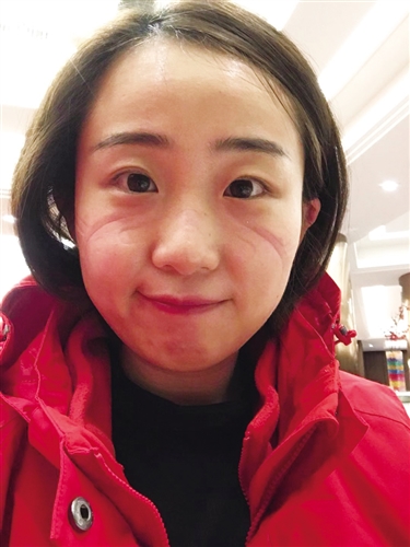 抗疫归来的张亚男脸上还有口罩的勒痕