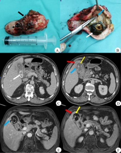 呼和浩特市第一医院医学影像科黄色肉芽肿性胆囊炎病例解析